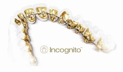 Ortodoncia lingual en Quintana y Ventas