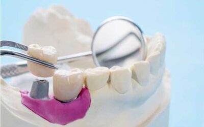 Implantes de carga inmediata