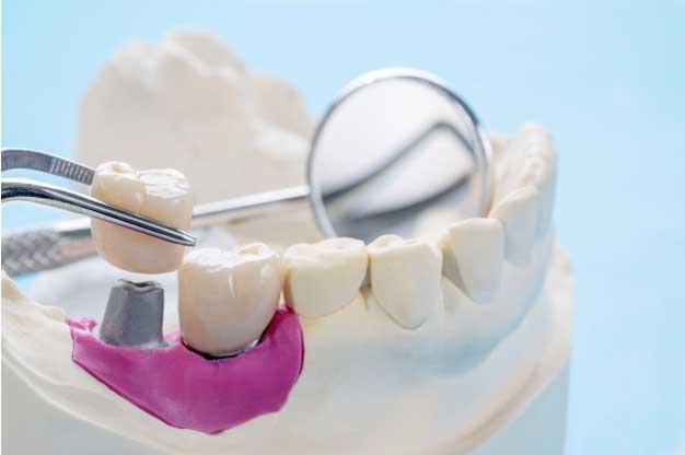 Implantes de carga inmediata