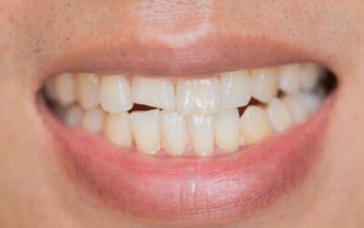 Fractura dental