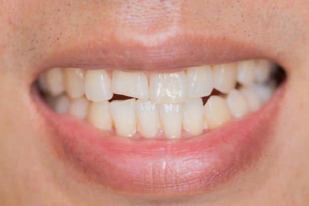Fractura dental
