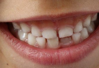 Maloclusión dental