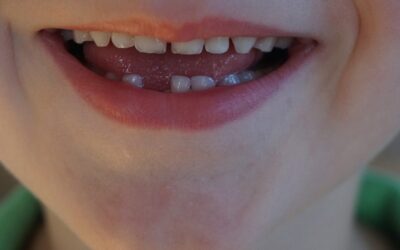 Dientes conoides, ¿cómo afectan a tu salud bucodental?