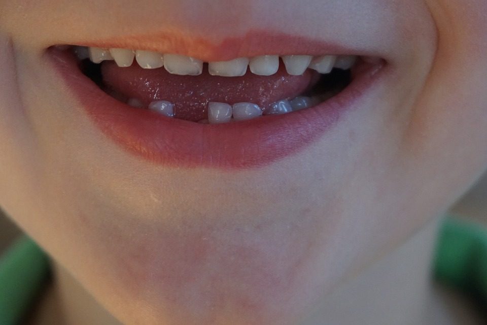 Dientes conoides, ¿cómo afectan a tu salud bucodental?