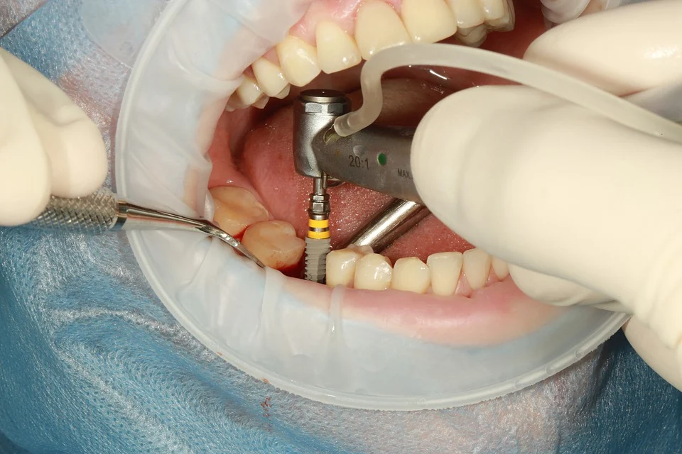 Mucositis periimplantaria