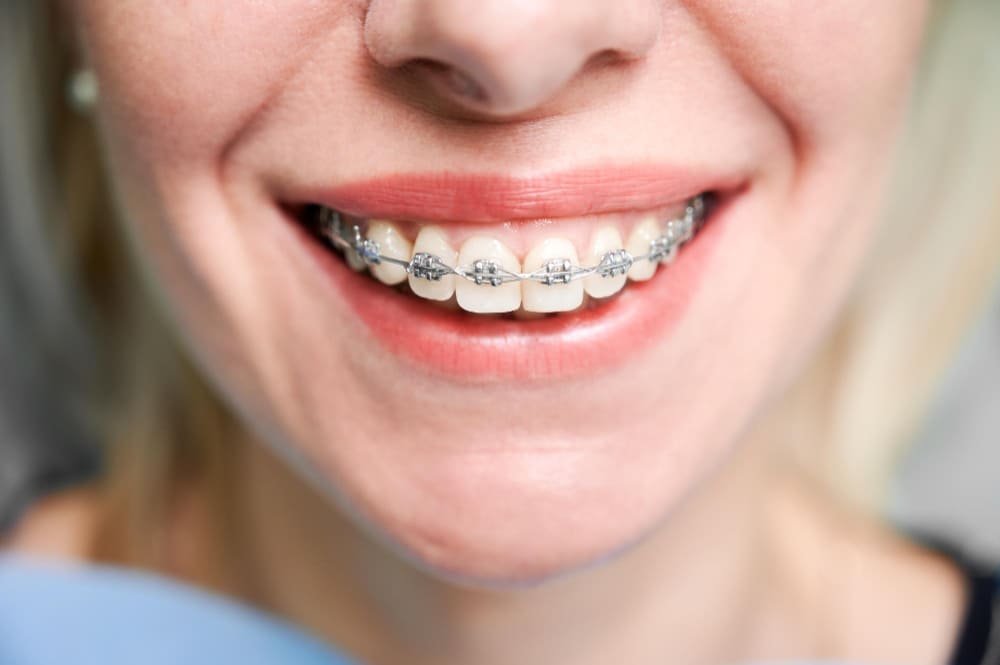 paciente sonrisa ortodoncia