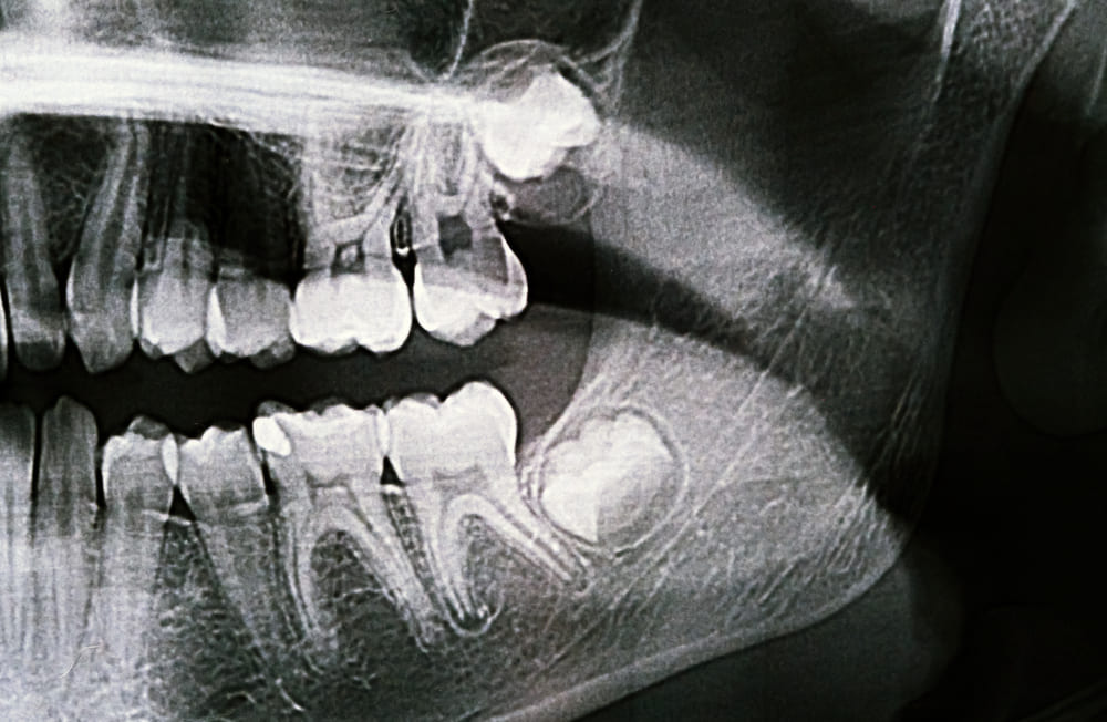 cirugia oral de extraccion de terceros molares con tecnologia digital en madrid cirugia oral de extraccion de terceros molares con tecnologia digital en madrid