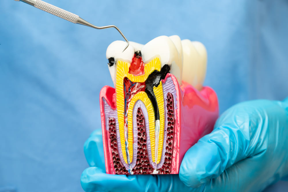 como saber si tienes una caries senales y sintomas tempranos